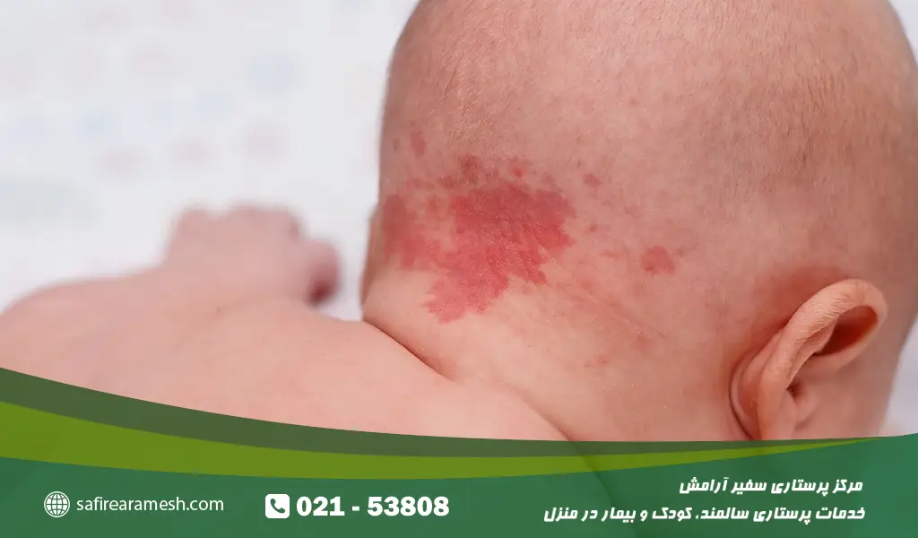 لکه های پوستی نوزادان و کودکان