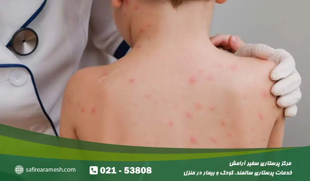 درمان حساسیت پوستی در کودکان