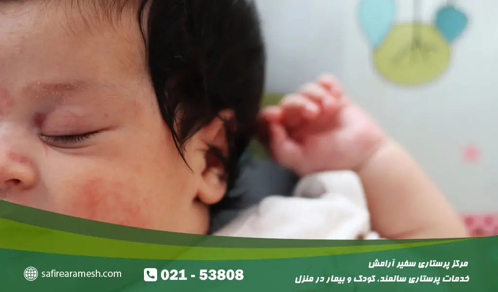 علائم حساسیت پوستی به پروتئین گاوی در نوزادان