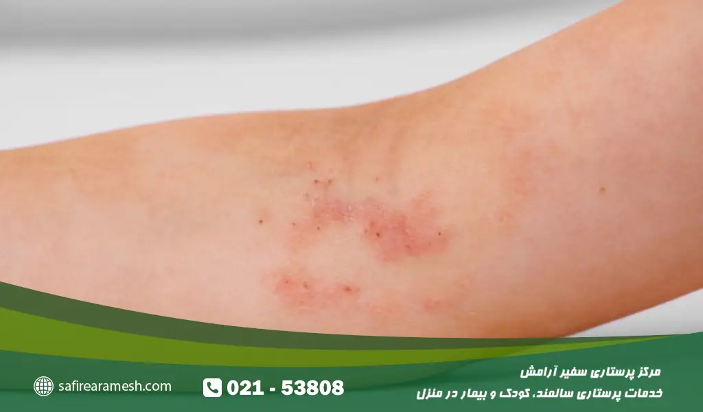 اگزما و حساسیت پوستس کودکان