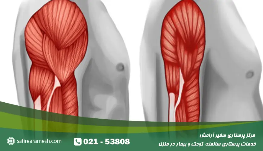 بیماری سارکوپنی سالمند