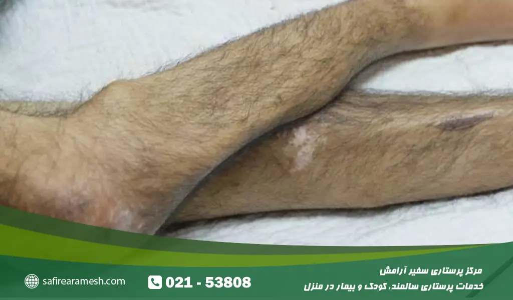 تشخیص سارکوپنی در سالمندان